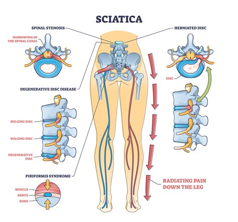 SCIATRICE definition .